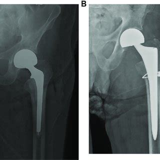 Prophylactic Bipolar Hemiarthroplasty of the Hip .